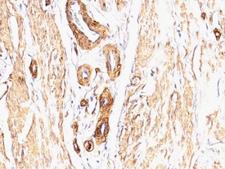 ACTA2 / Smooth Muscle Actin Antibody - Formalin-fixed, paraffin-embedded Leiomyosarcoma stained with Smooth Muscle Actin antibody (SPM332).  This image was taken for the unmodified form of this product. Other forms have not been tested.