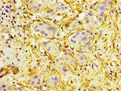 ACTA2 / Smooth Muscle Actin Antibody - IHC image of ACTA2 Antibody diluted at 1:300 and staining in paraffin-embedded human liver cancer performed on a Leica BondTM system. After dewaxing and hydration, antigen retrieval was mediated by high pressure in a citrate buffer (pH 6.0). Section was blocked with 10% normal goat serum 30min at RT. Then primary antibody (1% BSA) was incubated at 4°C overnight. The primary is detected by a biotinylated secondary antibody and visualized using an HRP conjugated SP system.