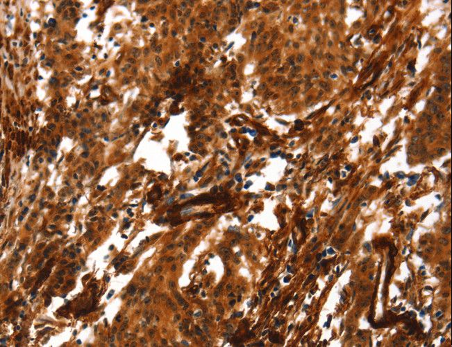 ACTA2 / Smooth Muscle Actin Antibody - Immunohistochemistry of paraffin-embedded Human gastric cancer using ACTA2 Polyclonal Antibody at dilution of 1:40.