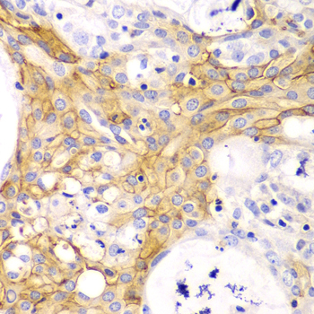 ACTA2 / Smooth Muscle Actin Antibody - Immunohistochemistry of paraffin-embedded human oophoroma using ACTA2 antibody at dilution of 1:100 (40x lens).