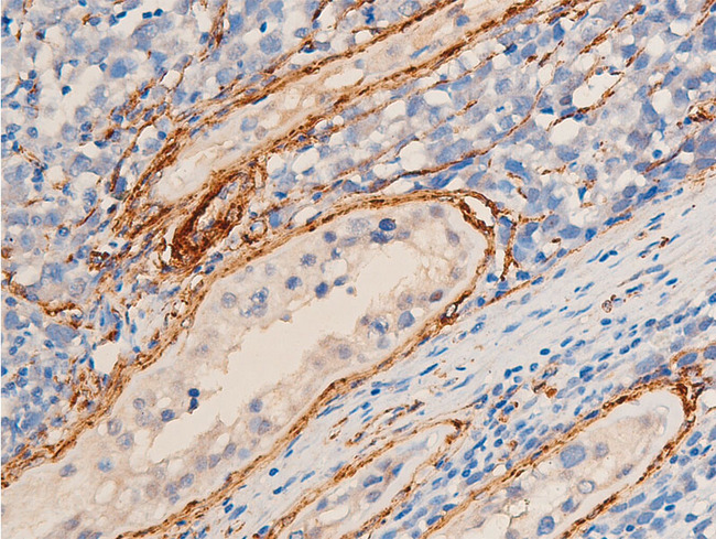 ACTA2 / Smooth Muscle Actin Antibody - 1:100 staining human seminoma tissue by IHC-P. The tissue was formaldehyde fixed and a heat mediated antigen retrieval step in citrate buffer was performed. The tissue was then blocked and incubated with the antibody for 1.5 hours at 22°C. An HRP conjugated goat anti-rabbit antibody was used as the secondary.