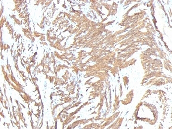 ACTA2 / Smooth Muscle Actin Antibody - Formalin-fixed, paraffin-embedded human Leiomyosarcoma stained with ACTA2 antibody.  This image was taken for the unmodified form of this product. Other forms have not been tested.