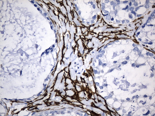 ACTA2 / Smooth Muscle Actin Antibody - Immunohistochemical staining of paraffin-embedded Adenocarcinoma of Human ovary tissue using anti-ACTA2. (smooth muscle actin alpha, SMA) mouse monoclonal antibody. (Heat-induced epitope retrieval by 1mM EDTA in 10mM Tris buffer. (pH8.5) at 120°C for 3 min. (1:3200)