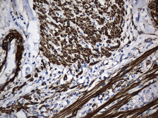 ACTA2 / Smooth Muscle Actin Antibody - Immunohistochemical staining of paraffin-embedded Carcinoma of Human pancreas tissue using anti-ACTA2. (smooth muscle actin alpha, SMA) mouse monoclonal antibody. (Heat-induced epitope retrieval by 1mM EDTA in 10mM Tris buffer. (pH8.5) at 120°C for 3 min. (1:3200)