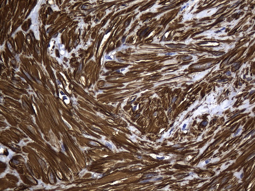 ACTA2 / Smooth Muscle Actin Antibody - Immunohistochemical staining of paraffin-embedded Human uterine leiomyoma tissue using anti-ACTA2. (smooth muscle actin alpha, SMA) mouse monoclonal antibody. (Heat-induced epitope retrieval by 1mM EDTA in 10mM Tris buffer. (pH8.5) at 120°C for 3 min. (1:3200)