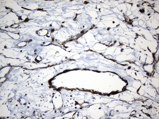 ACTA2 / Smooth Muscle Actin Antibody - Immunohistochemical staining of paraffin-embedded Carcinoma of Human kidney tissue using anti-ACTA2. (smooth muscle actin alpha, SMA) mouse monoclonal antibody. (Heat-induced epitope retrieval by 1mM EDTA in 10mM Tris buffer. (pH8.5) at 120°C for 3 min. (1:3200)