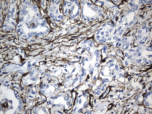 ACTA2 / Smooth Muscle Actin Antibody - Immunohistochemical staining of paraffin-embedded Carcinoma of Human liver tissue using anti-ACTA2. (smooth muscle actin alpha, SMA) mouse monoclonal antibody. (Heat-induced epitope retrieval by 1mM EDTA in 10mM Tris buffer. (pH8.5) at 120°C for 3 min. (1:3200)