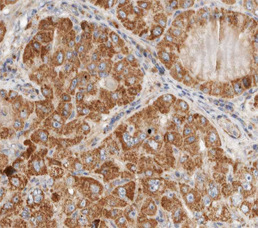 ACTB / Beta Actin Antibody - 1:100 staining human liver carcinoma tissues by IHC-P. The tissue was formaldehyde fixed and a heat mediated antigen retrieval step in citrate buffer was performed. The tissue was then blocked and incubated with the antibody for 1.5 hours at 22°C. An HRP conjugated goat anti-rabbit antibody was used as the secondary.