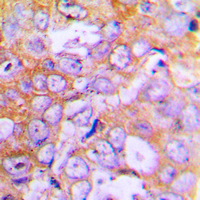 ACTB / Beta Actin Antibody - Immunohistochemical analysis of Beta-actin staining in human lung cancer formalin fixed paraffin embedded tissue section. The section was pre-treated using heat mediated antigen retrieval with sodium citrate buffer (pH 6.0). The section was then incubated with the antibody at room temperature and detected using an HRP conjugated compact polymer system. DAB was used as the chromogen. The section was then counterstained with hematoxylin and mounted with DPX.