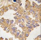ACTC1 / Alpha Cardiac Actin Antibody - Formalin-fixed and paraffin-embedded human lung carcinoma tissue reacted with ACTB/ACTC antibody , which was peroxidase-conjugated to the secondary antibody, followed by DAB staining. This data demonstrates the use of this antibody for immunohistochemistry; clinical relevance has not been evaluated.