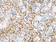 ACTC1 / Alpha Cardiac Actin Antibody - Immunohistochemistry of paraffin-embedded Human liver cancer tissue  using ACTC1 Polyclonal Antibody at dilution of 1:55(×200)