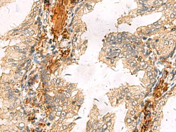 ACTC1 / Alpha Cardiac Actin Antibody - Immunohistochemistry of paraffin-embedded Human prost at e cancer tissue  using ACTC1 Polyclonal Antibody at dilution of 1:65(×200)