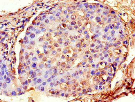 ACTG1 / Gamma Actin Antibody - Immunohistochemistry of paraffin-embedded human breast cancer using ACTG1 Antibody at dilution of 1:100