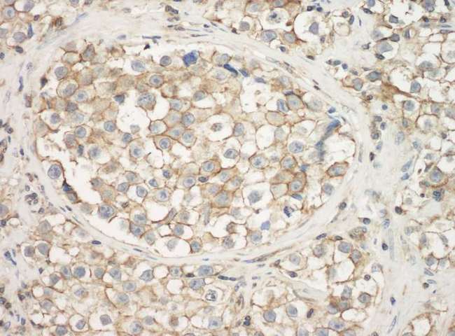 ACTG1 / Gamma Actin Antibody - Detection of Human Actin by Immunohistochemistry. Sample: FFPE section of human testicular seminoma. Antibody: Affinity purified rabbit anti-Actin used at a dilution of 1:1000 (1 ug/ml). Detection: DAB.