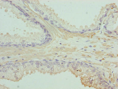 ACTG2 Antibody - Immunohistochemistry of paraffin-embedded human prostate cancer using ACTG2 Antibody at dilution of 1:100