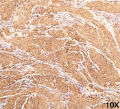 Actin Antibody - Muscle Actin antibody HHF35 immunohistochemistry leiomyosarcoma 10X.  This image was taken for the unmodified form of this product. Other forms have not been tested.