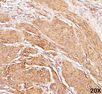 Actin Antibody - Muscle Actin antibody HHF35 immunohistochemistry leiomyosarcoma 20X.  This image was taken for the unmodified form of this product. Other forms have not been tested.