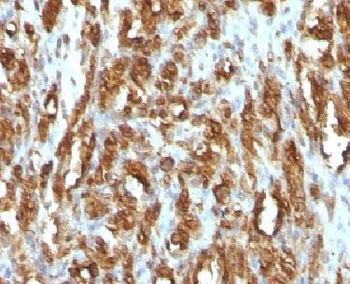 Actin Antibody - IHC testing of FFPE rhabdomyosarcoma with Muscle Actin antibody