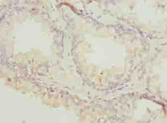 ACTL7B Antibody - Immunohistochemistry of paraffin-embedded human prostate cancer using antibody at dilution of 1:100.