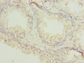 ACTL7B Antibody - Immunohistochemistry of paraffin-embedded human prostate cancer using ACTL7B Antibody at dilution of 1:100