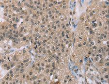 ACTN2 Antibody - Immunohistochemistry of paraffin-embedded Human breast cancer using ACTN2 Polyclonal Antibody at dilution of 1:30.
