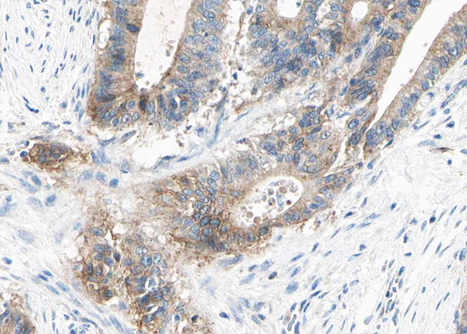 ACTN2 Antibody - 1:100 staining human liver carcinoma tissues by IHC-P. The tissue was formaldehyde fixed and a heat mediated antigen retrieval step in citrate buffer was performed. The tissue was then blocked and incubated with the antibody for 1.5 hours at 22°C. An HRP conjugated goat anti-rabbit antibody was used as the secondary.