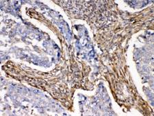 ACTN3 Antibody - IHC testing of FFPE human lung cancer tissue with ACTN3 antibody at 1ug/ml. HIER: steam sections in pH6 citrate buffer for 20 min.