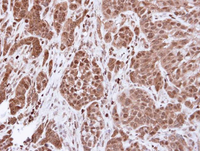 ACTN4 Antibody - IHC of paraffin-embedded A549 xenograft using alpha Actinin 4 antibody at 1:500 dilution.