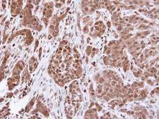 ACTN4 Antibody - IHC of paraffin-embedded A549 xenograft using alpha Actinin 4 antibody at 1:500 dilution.