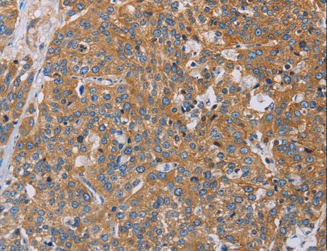 ACTN4 Antibody - Immunohistochemistry of paraffin-embedded Human esophagus cancer using ACTN4 Polyclonal Antibody at dilution of 1:60.