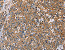 ACTN4 Antibody - Immunohistochemistry of paraffin-embedded Human esophagus cancer using ACTN4 Polyclonal Antibody at dilution of 1:60.