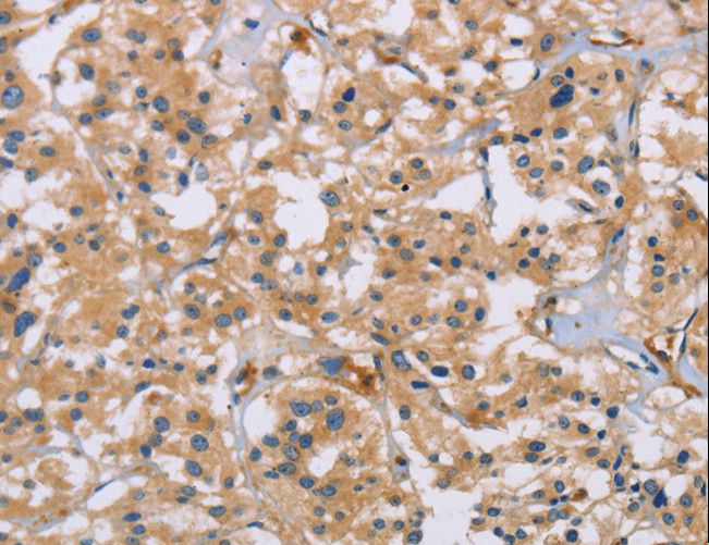 ACTN4 Antibody - Immunohistochemistry of paraffin-embedded Human thyroid cancer using ACTN4 Polyclonal Antibody at dilution of 1:60.