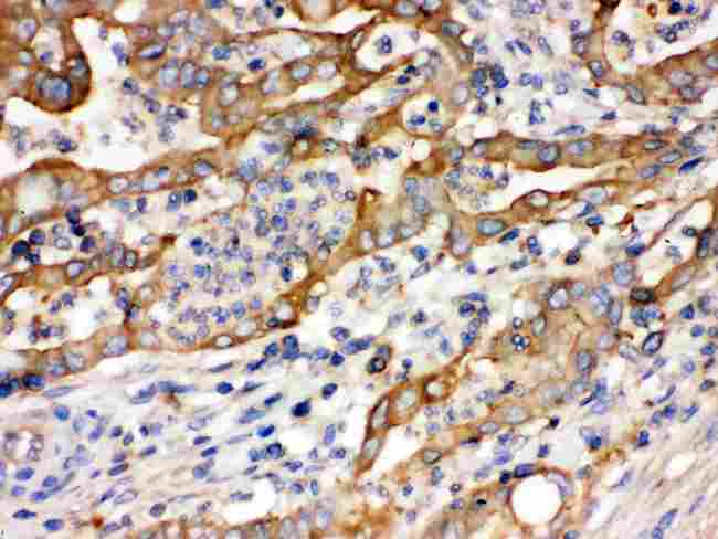 ACTN4 Antibody - Alpha Actinin 4 was detected in paraffin-embedded sections of human intestinal cancer tissues using rabbit anti- Alpha Actinin 4 Antigen Affinity purified polyclonal antibody