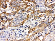 ACTN4 Antibody - IHC testing of FFPE human intestinal cancer tissue with ACTN4 antibody at 1ug/ml. HIER: steam in pH6 citrate buffer and allow to cool prior to staining.