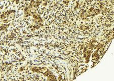 ACTN4 Antibody - 1:100 staining human breast carcinoma tissue by IHC-P. The sample was formaldehyde fixed and a heat mediated antigen retrieval step in citrate buffer was performed. The sample was then blocked and incubated with the antibody for 1.5 hours at 22°C. An HRP conjugated goat anti-rabbit antibody was used as the secondary.
