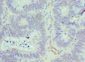 ACTR1A / Centractin Antibody - Immunohistochemistry of paraffin-embedded human colon cancer using antibody at 1:100 dilution.
