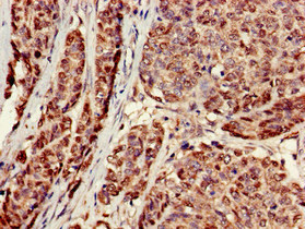 ACTR1A / Centractin Antibody - Immunohistochemistry of paraffin-embedded human ovarian cancer at dilution of 1:100