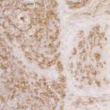 ACTR2 / ARP2 Antibody - Detection of human ACTR2 by immunohistochemistry. Sample: FFPE section of human skin squamous cell carcinoma. Antibody: Affinity purified rabbit anti-ACTR2 used at a dilution of 1:5,000 (0.2µg/ml). Detection: DAB