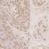 ACTR2 / ARP2 Antibody - Detection of human ACTR2 by immunohistochemistry. Sample: FFPE section of human skin squamous cell carcinoma. Antibody: Affinity purified rabbit anti-ACTR2 used at a dilution of 1:5,000 (0.2µg/ml). Detection: DAB. Counterstain: IHC Hematoxylin (blue).
