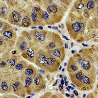 ACTR2 / ARP2 Antibody - Immunohistochemical analysis of ARP2 staining in human liver cancer formalin fixed paraffin embedded tissue section. The section was pre-treated using heat mediated antigen retrieval with sodium citrate buffer (pH 6.0). The section was then incubated with the antibody at room temperature and detected using an HRP conjugated compact polymer system. DAB was used as the chromogen. The section was then counterstained with hematoxylin and mounted with DPX.