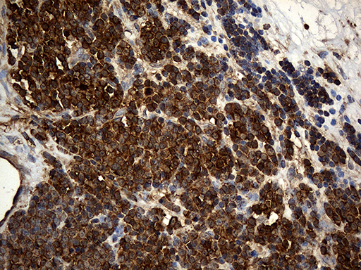 ACTR3 Antibody - Immunohistochemical staining of paraffin-embedded Human lymphoma tissue using anti-ACTR3 mouse monoclonal antibody. (Heat-induced epitope retrieval by 1mM EDTA in 10mM Tris buffer. (pH8.5) at 120°C for 3 min. (1:2000)
