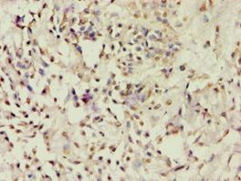 ACTRIIB / ACVR2B Antibody - Immunohistochemistry of paraffin-embedded human breast cancer using antibody at 1:100 dilution.