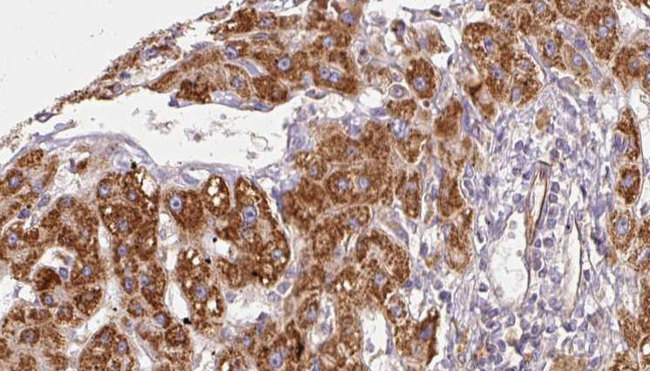 ACTRIIB / ACVR2B Antibody - 1:100 staining human liver carcinoma tissues by IHC-P. The sample was formaldehyde fixed and a heat mediated antigen retrieval step in citrate buffer was performed. The sample was then blocked and incubated with the antibody for 1.5 hours at 22°C. An HRP conjugated goat anti-rabbit antibody was used as the secondary.