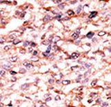 ACVR1C / ALK7 Antibody - Formalin-fixed and paraffin-embedded human cancer tissue reacted with the primary antibody, which was peroxidase-conjugated to the secondary antibody, followed by AEC staining. This data demonstrates the use of this antibody for immunohistochemistry; clinical relevance has not been evaluated. BC = breast carcinoma; HC = hepatocarcinoma.