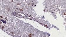 ACVR1C / ALK7 Antibody - 1:100 staining human brain carcinoma tissue by IHC-P. The sample was formaldehyde fixed and a heat mediated antigen retrieval step in citrate buffer was performed. The sample was then blocked and incubated with the antibody for 1.5 hours at 22°C. An HRP conjugated goat anti-rabbit antibody was used as the secondary.