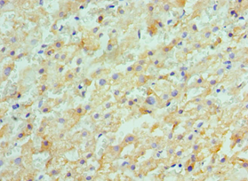 ACVR2 / ACVR2A Antibody - Immunohistochemistry of paraffin-embedded human liver cancer using antibody at 1:100 dilution.