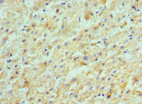ACVR2 / ACVR2A Antibody - Immunohistochemistry of paraffin-embedded human liver cancer using ACVR2A Antibody at dilution of 1:100