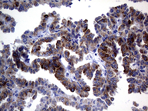 ACVR2 / ACVR2A Antibody - Immunohistochemical staining of paraffin-embedded Carcinoma of Human thyroid tissue using anti-ACVR2A mouse monoclonal antibody. (Heat-induced epitope retrieval by 1mM EDTA in 10mM Tris buffer. (pH8.5) at 120°C for 3 min. (1:2000)