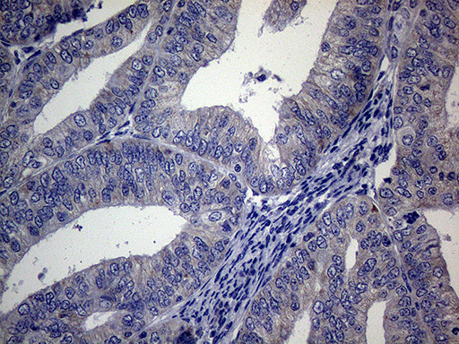 ACVR2 / ACVR2A Antibody - Immunohistochemical staining of paraffin-embedded Adenocarcinoma of Human endometrium tissue using anti-ACVR2A mouse monoclonal antibody. (Heat-induced epitope retrieval by 1mM EDTA in 10mM Tris buffer. (pH8.5) at 120°C for 3 min. (1:2000)
