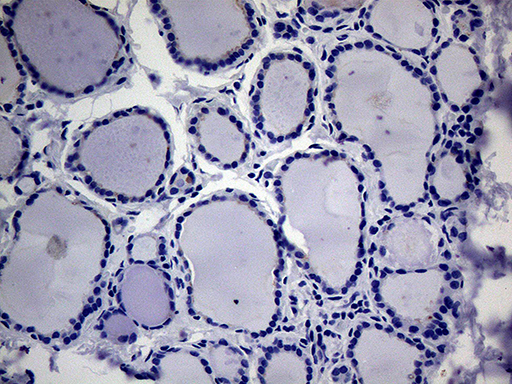 ACVR2 / ACVR2A Antibody - Immunohistochemical staining of paraffin-embedded Human thyroid tissue within the normal limits using anti-ACVR2A mouse monoclonal antibody.This figure shows negative staining. (Heat-induced epitope retrieval by 1mM EDTA in 10mM Tris buffer. (pH8.5) at 120°C for 3 min. (1:2000)